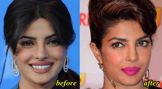 Priyanka Chopra Nose Job Before And After picture 02