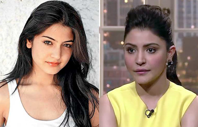 Bollywood Actresses Plastic Surgery Gone Wrong Before And After Pictures