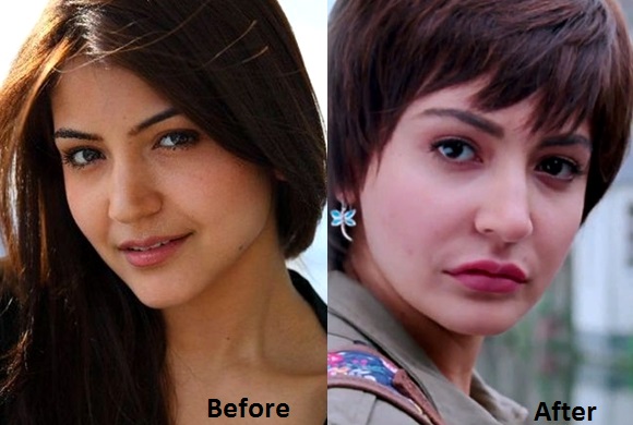Bollywood Celebrities Who Had Plastic Surgery